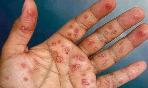 X&#233;t nghiệm chẩn đo&#225;n v&#224; điều trị bệnh giang mai