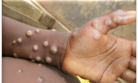 WHO khuyến c&#225;o điều trị HIV sớm cho bệnh nh&#226;n đồng nhiễm Mpox