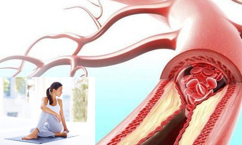 4 thay đổi lối sống hàng đầu giúp giảm nguy cơ tắc nghẽn động mạch