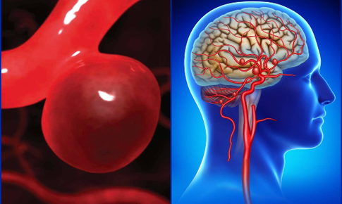 Phình động mạch não có nguy hiểm không?