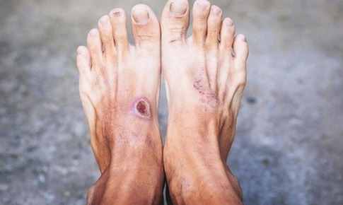 Bước đột ph&#225; mới trong điều trị bệnh tiểu đường tu&#253;p 1