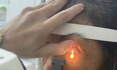 Bỏng mắt v&#236; gội đầu bằng rượu ng&#226;m hạt na