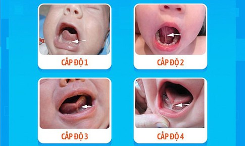 Dị tật bẩm sinh khiến trẻ kh&#243; b&#250;, kh&#243; ph&#225;t &#226;m