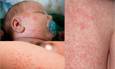 Công dụng làm mát, hỗ trợ phòng rôm sảy từ trà Shan Tuyết vùng cao