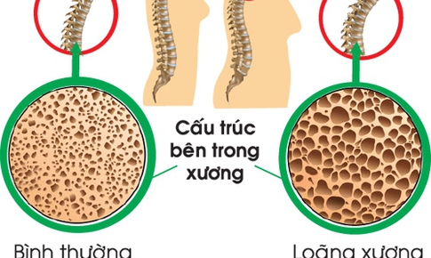 Lo&#227;ng xương: Ai cần đo mật độ xương v&#224; c&#225;ch ph&#242;ng ngừa hiệu quả?
