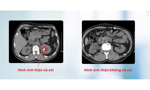 Tán sỏi qua da cho người đàn ông bị dị tật thận đôi cực hiếm