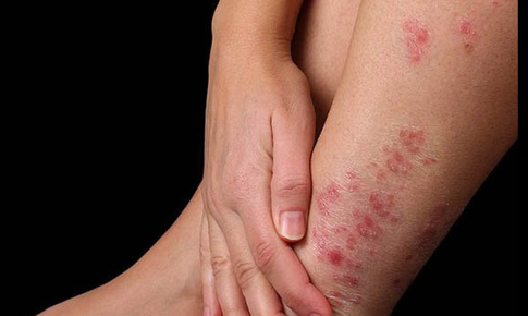 Phát hiện sớm bệnh ngoài da mùa mưa lũ