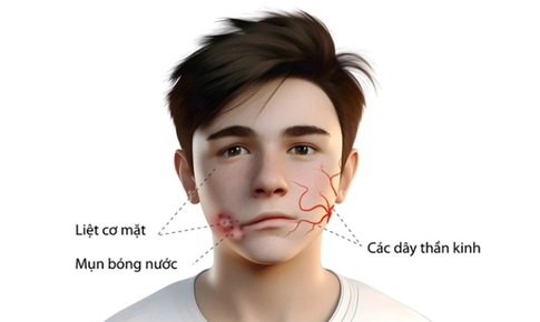 Liệt mặt do zona có biểu hiện như thế nào?