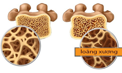 Loãng xương: Dự phòng và điều trị từ lối sống đến thuốc