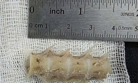 Xương cá kích thước 'khủng' găm chặt vào thực quản cụ ông 99 tuổi