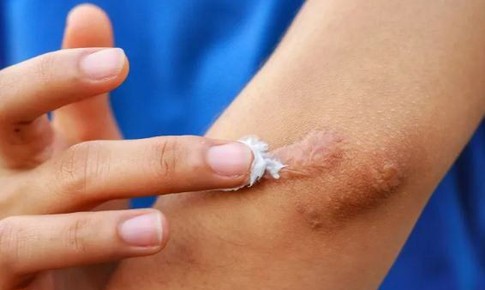 Bộ Y tế đ&#236;nh chỉ, thu hồi to&#224;n quốc, y&#234;u cầu ti&#234;u huỷ 1 loại gel &#39;ngừa sẹo&#39; do vi phạm 3 lỗi