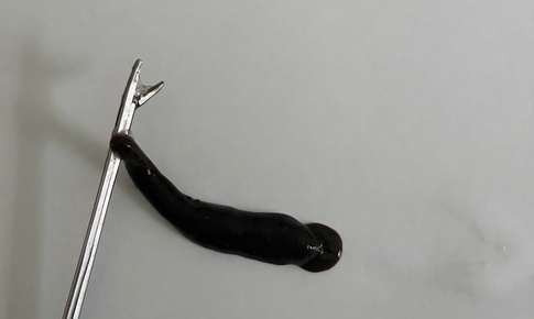 Đỉa d&#224;i 4cm k&#253; sinh trong mũi b&#233; trai suốt 10 ng&#224;y