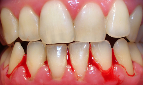 H&#224;nh tr&#236;nh &#39;giải cứu&#39; nướu vi&#234;m: Từ thảo dược tự nhi&#234;n đến liệu ph&#225;p chuy&#234;n s&#226;u