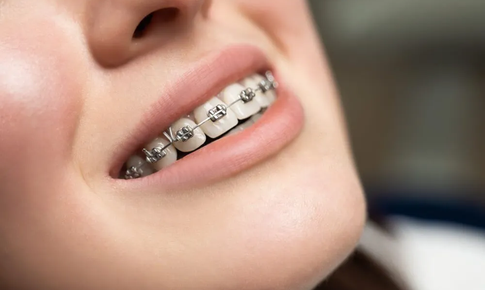 Vệ sinh răng nướu sau khi niềng răng: Bạn đ&#227; biết chưa?
