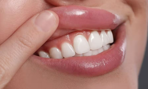 Bỏ qu&#234;n khe nướu (lợi) - l&#253; do đau răng, vi&#234;m nướu (lợi)  k&#233;o d&#224;i
