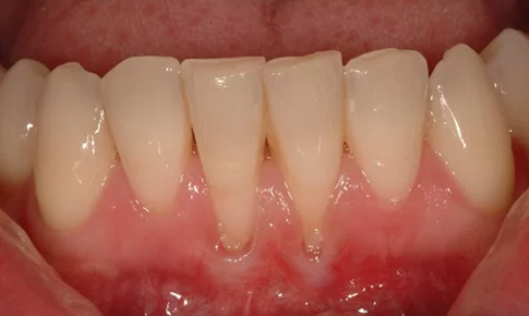 Tụt nướu ‘kh&#244;ng phanh’: Phục hồi nướu (lợi)  thẩm mỹ, lấy lại nụ cười rạng ngời