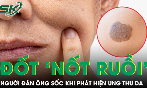 Liên tục đốt ‘nốt ruồi’ không hết, người đàn ông trẻ sốc khi phát hiện mắc ung thư da