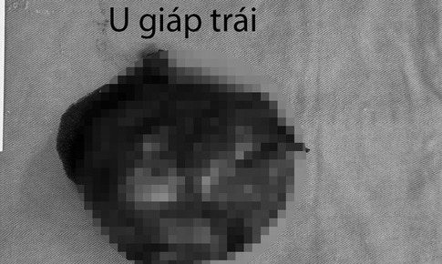 Su&#253;t mất mạng v&#236; chủ quan với bướu gi&#225;p l&#224;nh t&#237;nh