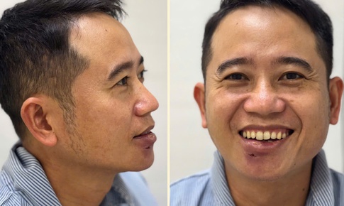 Tự điều trị mụn, nam bệnh nh&#226;n nhập viện v&#236; &#225;p xe sưng to v&#249;ng m&#244;i dưới