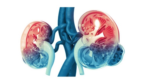 Ph&#225;t hiện chấn thương thận qua 3 dấu hiệu điển h&#236;nh