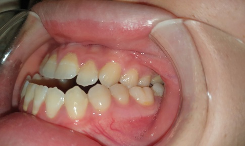 Điều trị móm (khớp cắn ngược) do xương hàm
