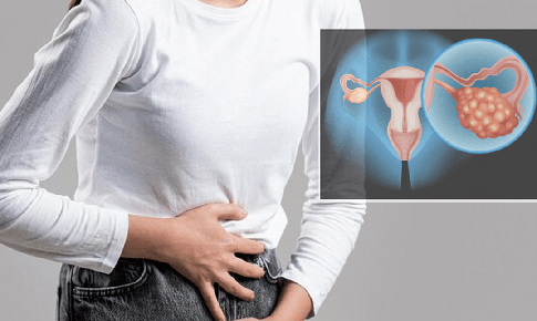 C&#243; thể ph&#225;t hiện sớm ung thư buồng trứng kh&#244;ng?