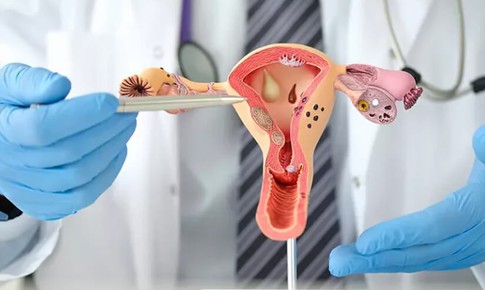 Nguy&#234;n nh&#226;n g&#226;y buồng trứng đa nang