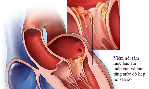 Triệu chứng viêm nội tâm mạc nhiễm trùng