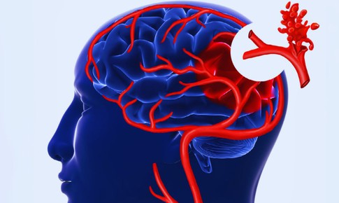 Nguy cơ đột quỵ do vỡ t&#250;i ph&#236;nh mạch n&#227;o