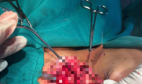 Cứu sống bệnh nh&#226;n bị d&#226;y điện s&#224; giữa đường cứa đứt kh&#237; quản