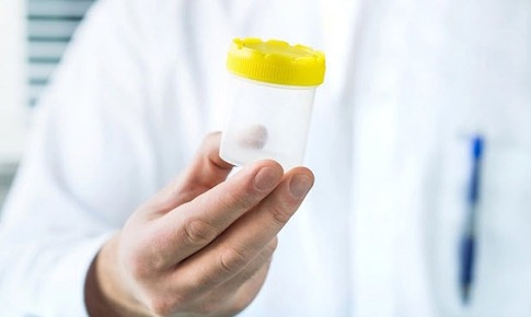 Hormone v&#224; tinh tr&#249;ng nam suy giảm v&#236; bệnh m&#227;n t&#237;nh