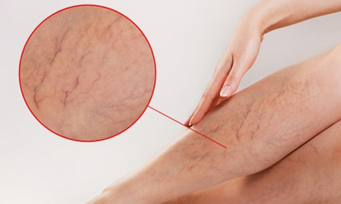 Suy gi&#227;n tĩnh mạch tiến triển: Đừng chủ quan với những dấu hiệu ban đầu
