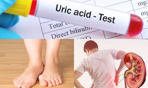 4 b&#224;i tập đơn giản gi&#250;p hạ axit uric ngăn ngừa mắc gout (g&#250;t)