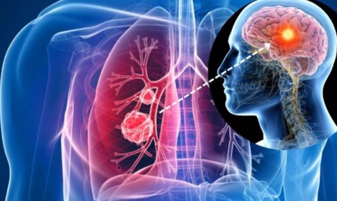 5 b&#237; quyết ph&#242;ng ngừa ung thư phổi cần biết