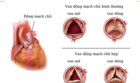 Biến chứng nguy hiểm hẹp van động mạch chủ v&#224; c&#225;ch điều trị