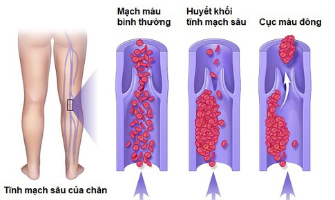C&#225;c yếu tố nguy cơ g&#226;y bệnh huyết khối tĩnh mạch s&#226;u