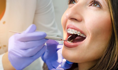 N&#234;n ăn g&#236; khi niềng răng để đảm bảo dinh dưỡng?