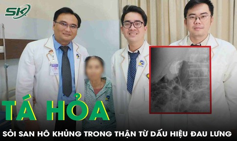 Đau lưng âm ỉ, cụ bà 71 tuổi tá hỏa vì sỏi san hô khủng trong thận
