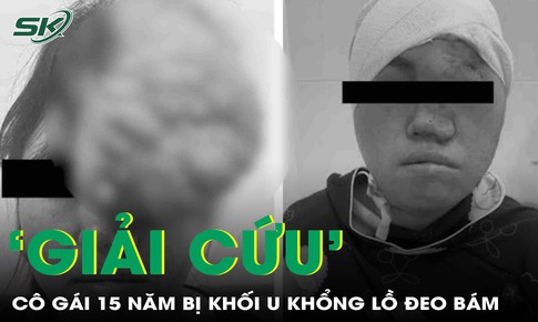 Giải cứu khuôn mặt cô gái sau 15 năm mang khối u khổng lồ