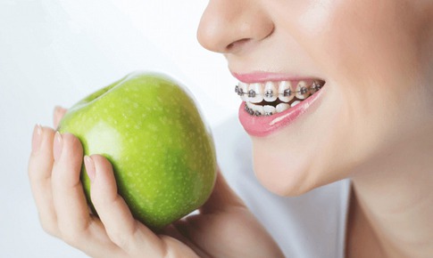 5 loại thực phẩm n&#234;n ki&#234;ng khi niềng răng