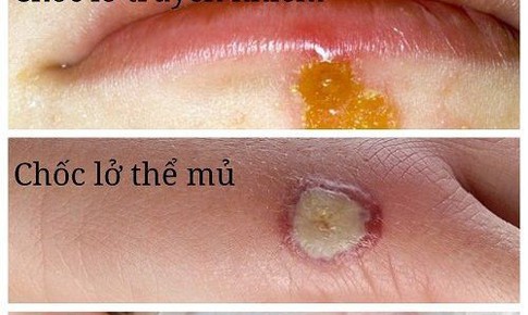 Bệnh chốc lở - Dùng thuốc nào để điều trị?