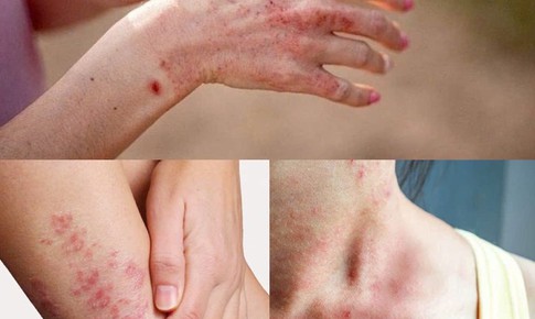 Thuốc điều trị vi&#234;m da trong m&#249;a mưa