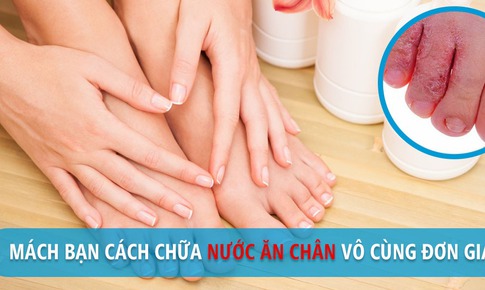 Nước ăn ch&#226;n - D&#249;ng thuốc v&#224; c&#225;c phương ph&#225;p chữa trị tại nh&#224;