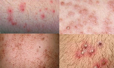 Điều trị vi&#234;m nang l&#244;ng bằng thuốc - Khi n&#224;o cần sử dụng?