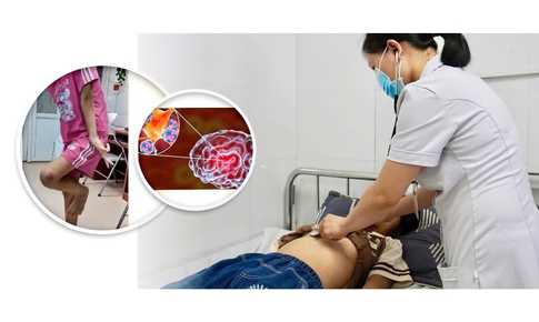 Cứu sống bé gái 12 tuổi bị viêm não tự miễn