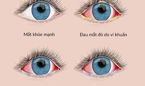 Đau mắt đỏ - Thuốc trị theo nguy&#234;n nh&#226;n v&#224; những biện ph&#225;p hỗ trợ kh&#244;ng d&#249;ng thuốc