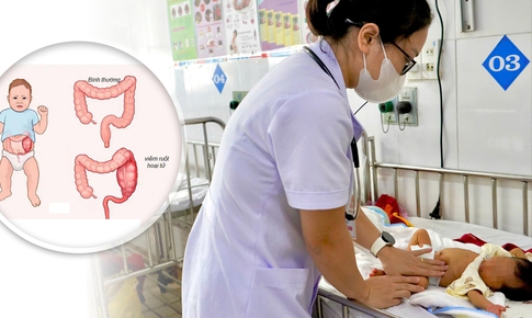 Cứu sống trẻ sinh non bị viêm ruột hoại tử