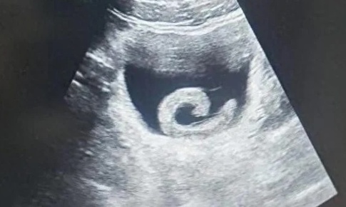 Người đàn ông phải nhập viện cấp cứu vì… đỉa sống trong bàng quang