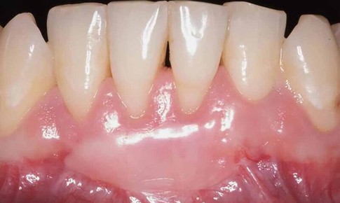 Những điều nên và không nên sau ghép lợi