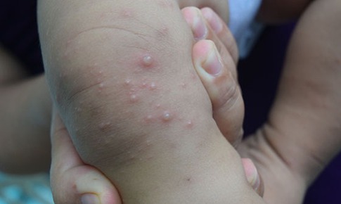 7 cách phòng bệnh tay chân miệng ở trẻ em
